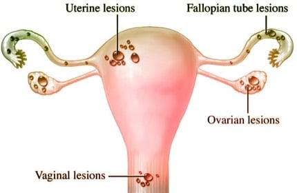 symptoms of Endometriosis